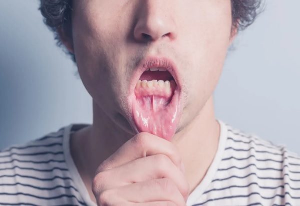 Jak wybrać żel na afty dopasowany do indywidualnych potrzeb?