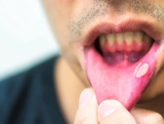 Czy żele na afty różnią się skutecznością?