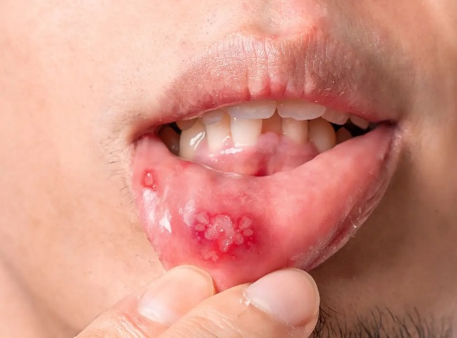 Czy żel na afty działa od razu po aplikacji?